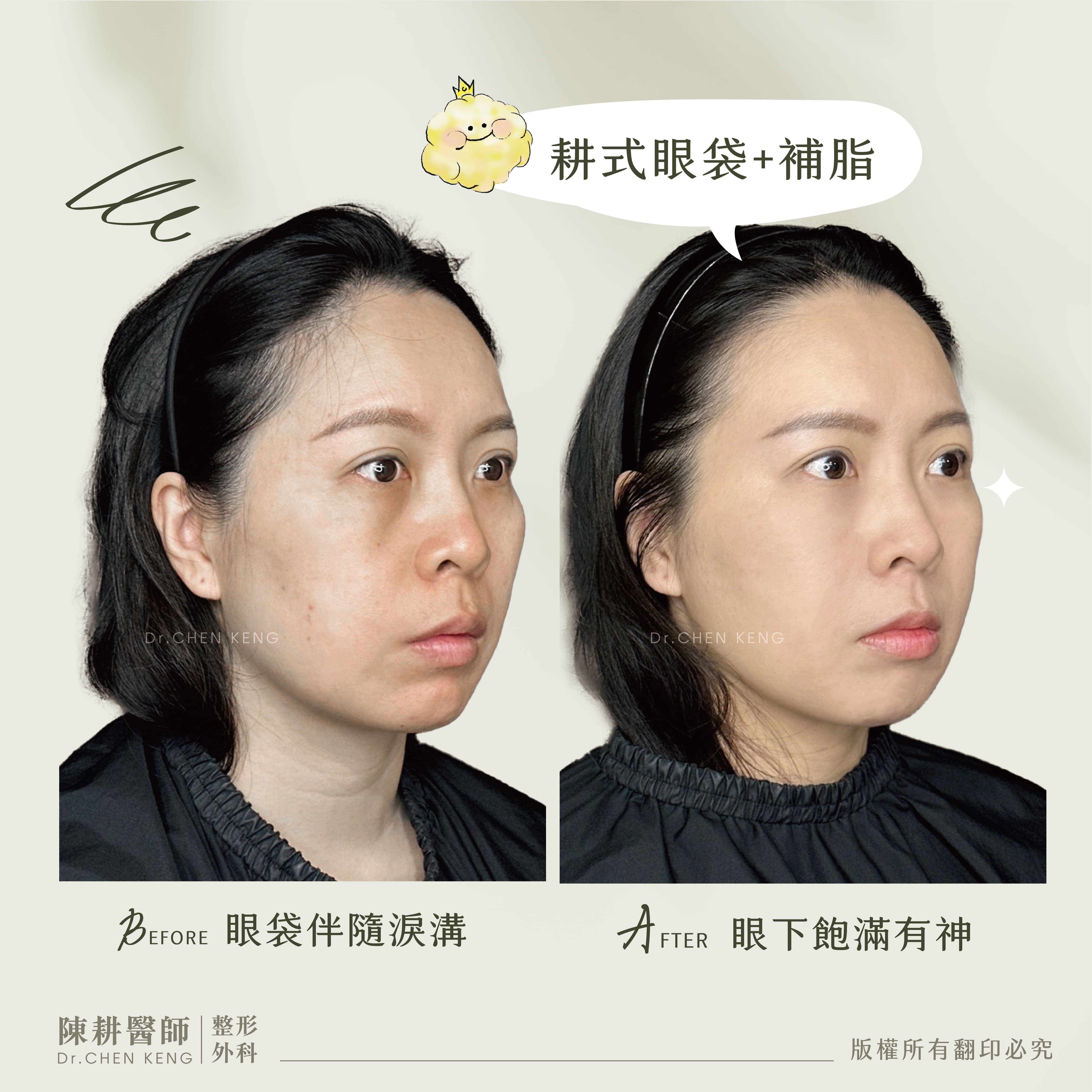 眼袋補脂